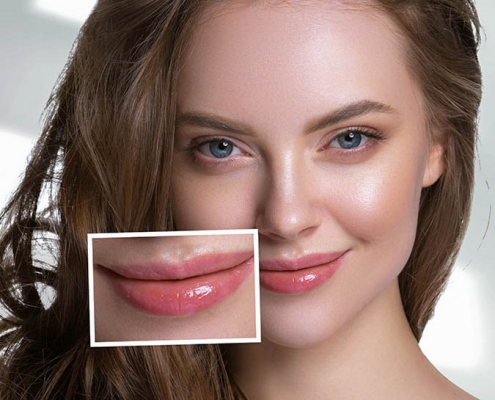 lippenkorrektur-filler-uebersicht