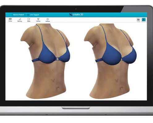 crisalix-simulation-bikini