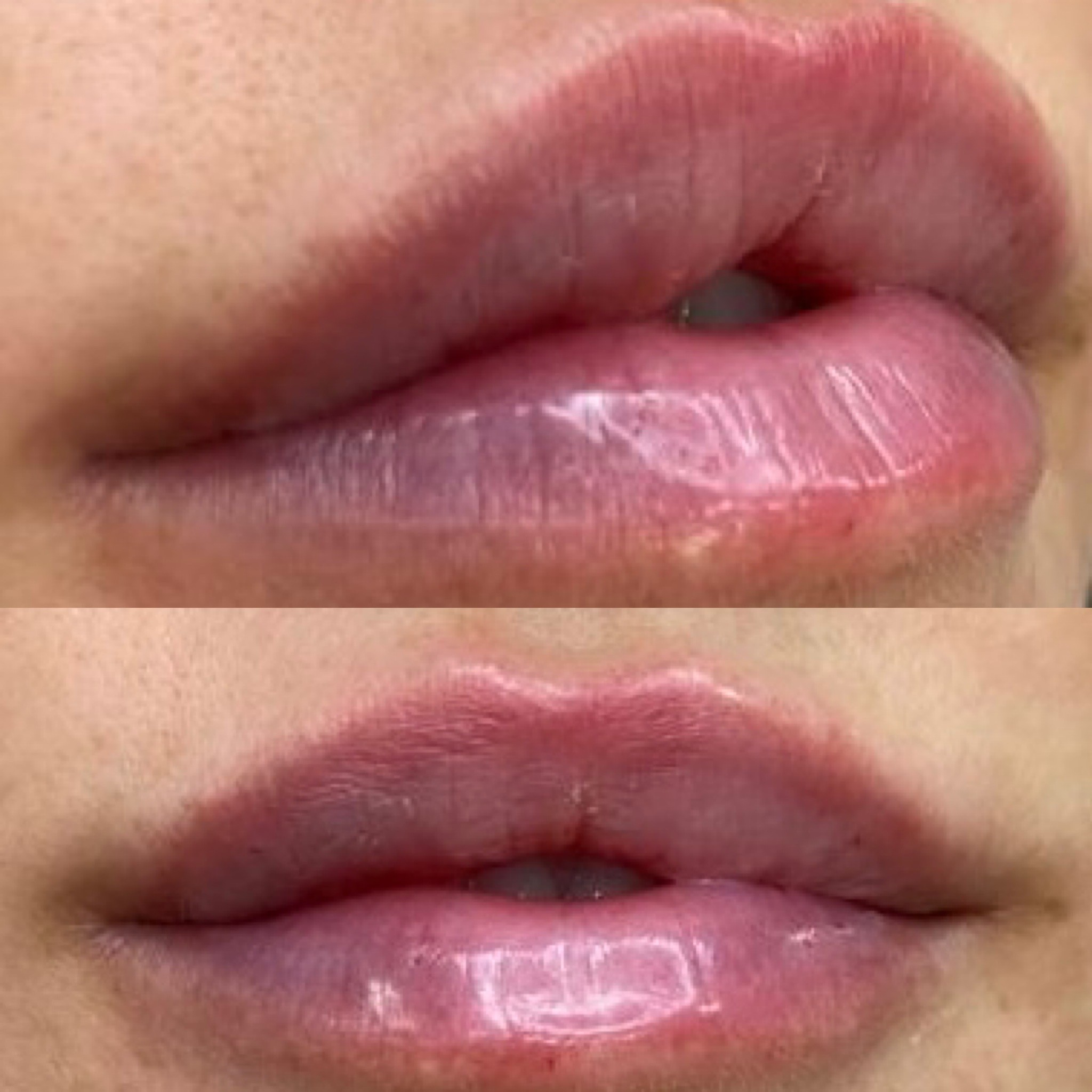 lippenkorrektur-vorher-nachher-231023