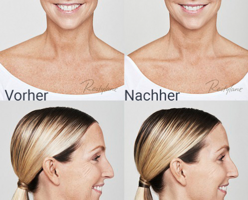 camilla-skinbooster-vorhernachher