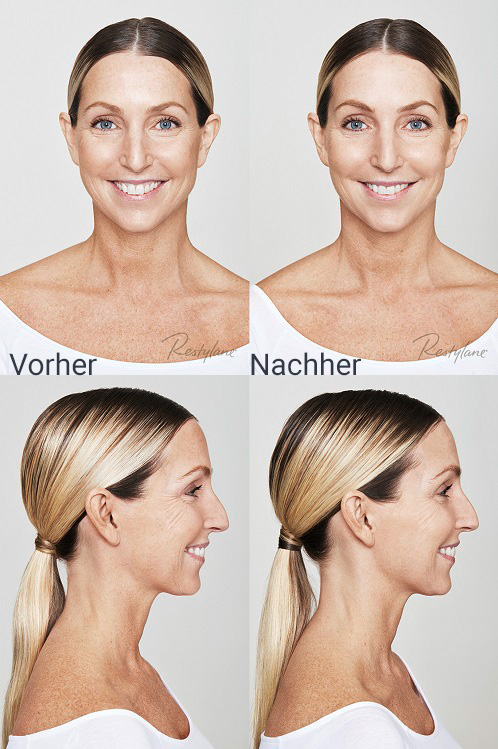 camilla-skinbooster-vorhernachher