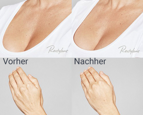 jenny-skinbooster-vorhernachher