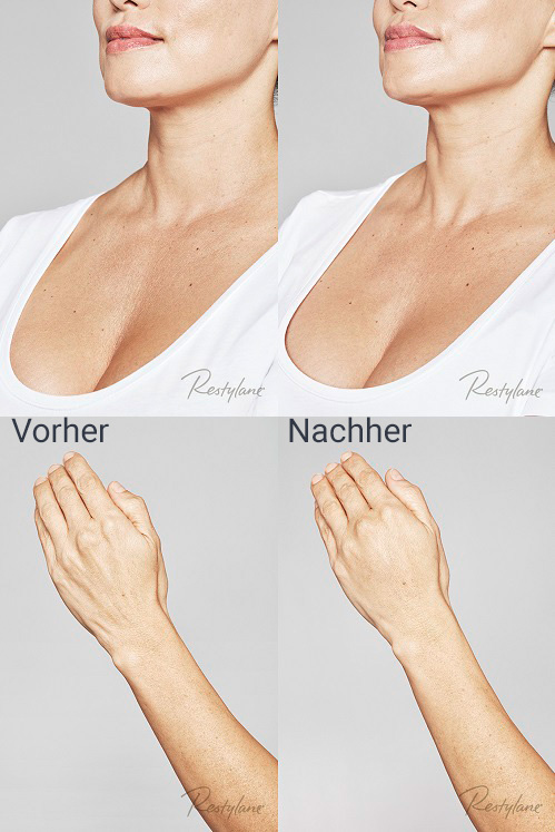 jenny-skinbooster-vorhernachher