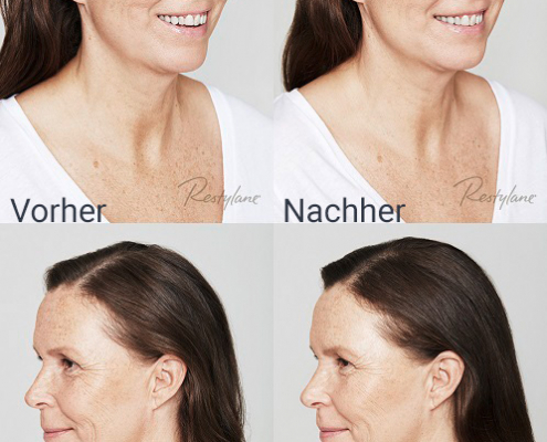 katriina-skinbooster-vorhernachher