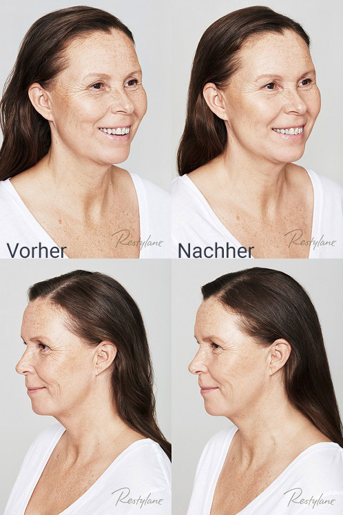 katriina-skinbooster-vorhernachher