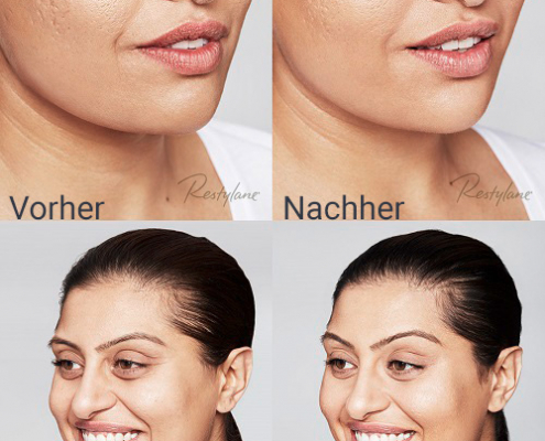 rafat-skinbooster-vorhernachher