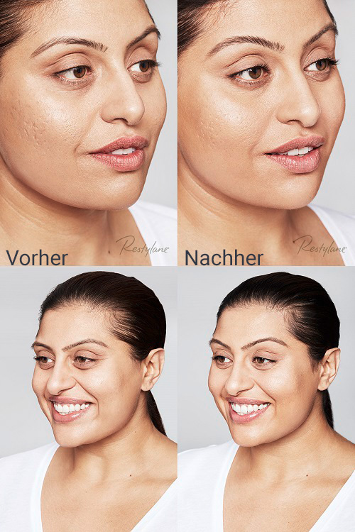rafat-skinbooster-vorhernachher