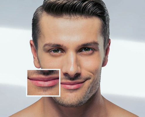 filler-uebersicht-lippenkorrektur-m
